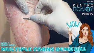 Multiple Corns amp calluses removalΑφαίρεση πολλαπλών κάλωνΠοδιατρικήΚέντρο Ποδιού PodiatryPart 1 [upl. by Ahsinak]