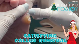 Satisfying Callus removalΑφαίρεση κάλουΚέντρο Ποδιού PodiatryPodiatristPodologosΠοδίατροςΠόδια [upl. by Netsrik]