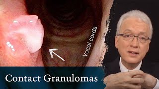 Contact Granulomas or Contact Ulcers [upl. by Sugar]