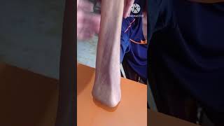 olecranon fracture physiotherapy exercise1 years full recovery olecranon [upl. by Nylkcaj309]