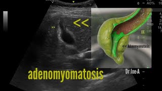 Fundal segmental adenomyomatosis of gallbladder ultrasound and color Doppler video [upl. by Lenoel]