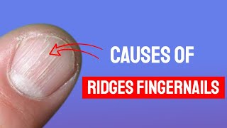 Vertical Ridges On Fingernails  What Causes Fingernail Ridges amp How to Treat [upl. by Semela173]