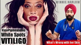 WHITE SPOTS  VITILIGO  HYPOPIGMENTATION  LEUCODERMA  Winnie Harlow Skin in ENG by DrEducation [upl. by Aicrop]