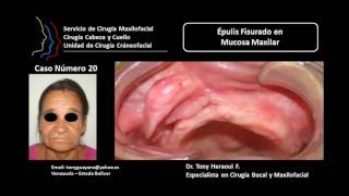 Tony Heraoui Cirugía Maxilofacial Caso 20 [upl. by Allecnirp]