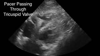 Emergency Transvenous Pacemaker Placement Guided w POCUS [upl. by Karrah]