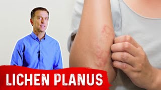 Lichen Planus Best Remedy [upl. by Chap721]