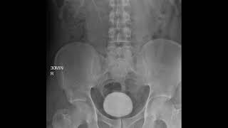 CASE 395 intravenous pyelography IVP left renal agenesis [upl. by Ayahsey]