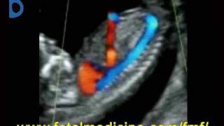 Fetal Medicine Foundation  Ductus venosus [upl. by Eniagrom]