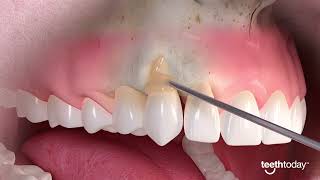 Mastering Gum Recession Treatment Advance Dental Implant and TMJ Center [upl. by Merv]