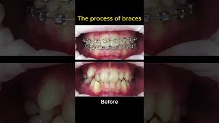 The process of braces 26 months [upl. by Mcquoid]