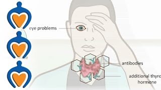 Thyroid problems  most common thyroid problems symptoms and treatment [upl. by Latham]