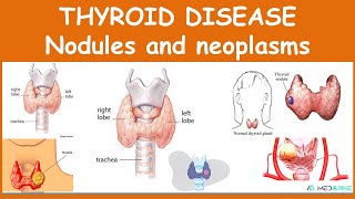 Thyroid Diseases Nodules and Neoplasms [upl. by Alenson]