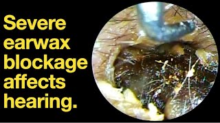 Severe earwax blockage affects hearingear wax removal  ear cleaning  ASMR  relaxation  relax [upl. by Kerrie]