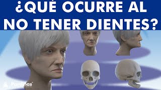 ¿Qué cambios ocurren al no tener dientes Edentulismo y resorción ósea por falta de dientes © [upl. by Eizdnil]