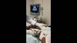 Emergency Ultrasound Guided Percutaneous Nephrostomy Tube placement [upl. by Bolton]