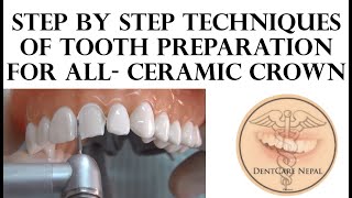 All Ceramic Crown Prep in 5 Minutes The 5x5x5 Technique [upl. by Nadual]