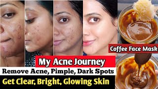 I used Coffee face pack for remove Acne pimple dark spots free skin coffee face mask skin whitening [upl. by Nairbo]