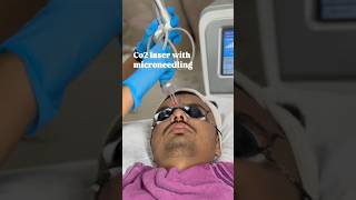 Co2 fractional laser with microneedling Treatment skin smile clinic Bhopal ✅skincare [upl. by Camilia]