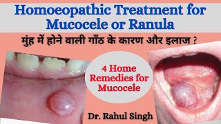 How To Treat Mucocele होंठ की गाँठ का इलाज और कारण Homeopathic Medicine for Oral Mucocele amp Ranula [upl. by Charleen798]