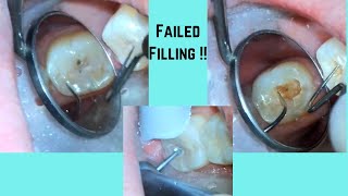 Replacing a white filling [upl. by Castro]