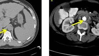 Introduction to Radiology Computed Tomography [upl. by Denoting341]