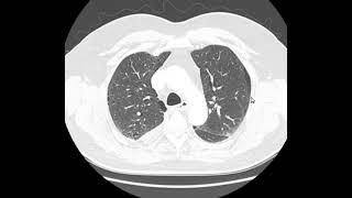 Enfisema pulmonar [upl. by Levy495]