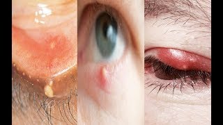 Hordeolum vs chalazion vs blepharitis [upl. by Libbie]