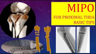 MIPO for Proximal Tibia Fractures Stepwise Basics [upl. by Edualc573]