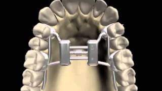 O aparelho no céu da boca disjuntor palatino [upl. by Anwahsal]
