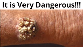 🔥 It is very dangerous Warts  symptoms treatment prevention [upl. by Lashar401]