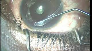 CAIRS Corneal Allogeneic Intrastromal Ring Segments for keratoconus ectasias amp irregular corneas [upl. by Intisar577]