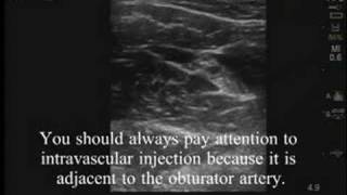 UltrasoundGuided Obturator Nerve Block [upl. by Elisabeth]