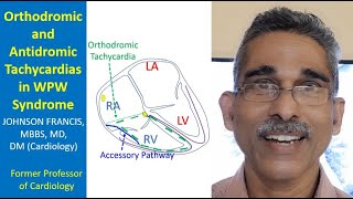 Orthodromic and Antidromic Tachycardias in WPW Syndrome [upl. by Hynes]