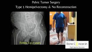 Treatment for Bone Cancer Chondrosarcoma Pelvic Tumour SurgeryHemipelvectomy Dr Srimanth B S [upl. by Collin]