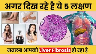 what is liver fibrosis  causes and symptoms of liver fibrosis  liver fibrosis treatment [upl. by Atneciv]