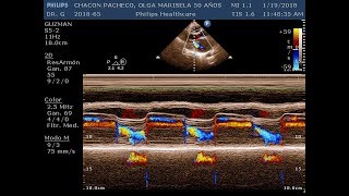 Doble Lesión Mitral reumatica [upl. by Barbi136]