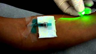 Intravenöse Laserblutbestrahlung mit dem Weberneedle® Endo Laser [upl. by Noiram483]