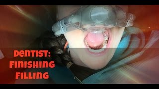 Dentist Finishing Filling [upl. by Becht]