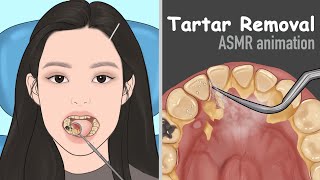 ASMR Tartar removal animation  Dental Scaling  Satisfying [upl. by Xyno]