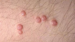 DermTV  Molluscum Contagiosum DermTVcom Epi 445 [upl. by Eimma]