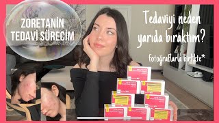 ZORETANİN TEDAVİ SÜRECİM💊  Tedaviyi neden yarıda bıraktım Yan etkileri nasıldı [upl. by Enttirb241]