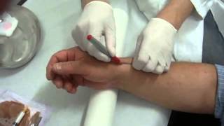 UltrasoundGuided Corticosteroid Injection for the Treatment of de Quervains Tenosynovitis [upl. by Alexandria]