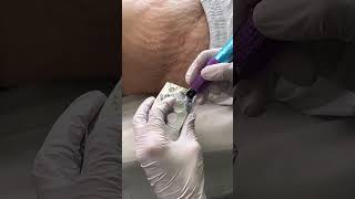 Stretch Marks Inkless Removal Boleyn Treatment Los Angeles 🌍 shorts [upl. by Legir408]