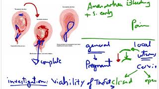 Abortion 2 quot Threatened abortion and its fates quot [upl. by Gosser]