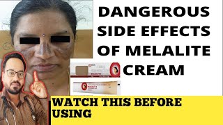 Melalite Cream Review  इस क्रीम का इस्तेमाल ना करें [upl. by Ardnassak]