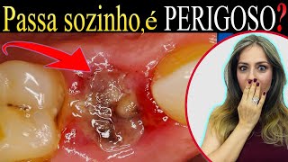 COMO RESOLVER a Alveolite Seca DOR ou Inflamação no LOCAL da Extração de Dente 74 [upl. by Ambrosi]