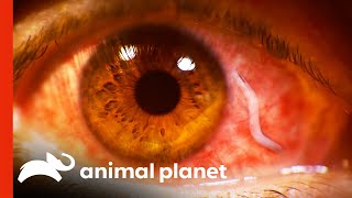 Doctors Remove Huge Parasite From Eyeball  Monsters Inside Me [upl. by Anelys993]