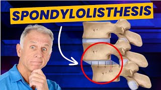 Spondylolisthesis 4 Exercises to Reduce Pain Demo on Real Patient [upl. by Sral]