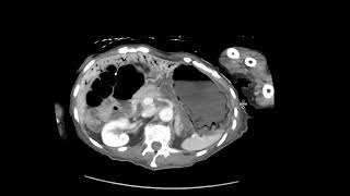 Gastric Pneumatosis with Portal venous gas [upl. by Gunthar172]