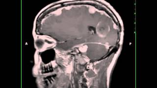 Neurofibromatosis Type 2 [upl. by Gorden]